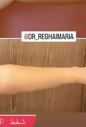 Après liposuccion des bras technique J Plasma